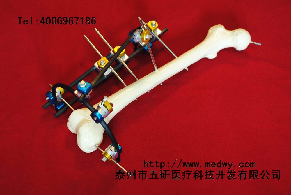 骨折、關(guān)節(jié)炎與四肢畸形患者福音