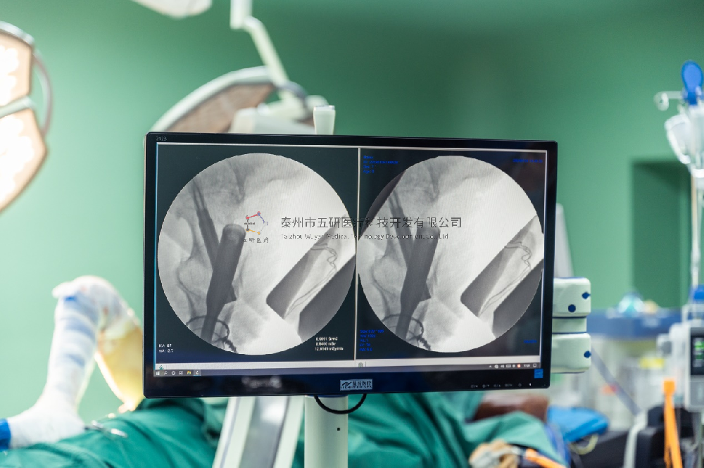 強(qiáng)直性脊柱炎既往病史，股骨粗隆下骨折